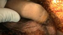 circoncisione_estetica_21-10-12-mp4-1